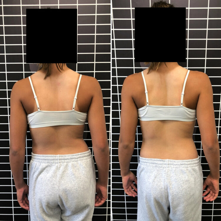 Before and after back photos of a teen patient, face covered