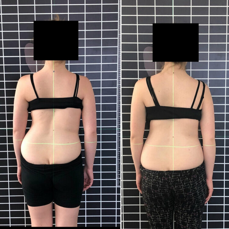 Before and after back photos of an adult patient, face covered