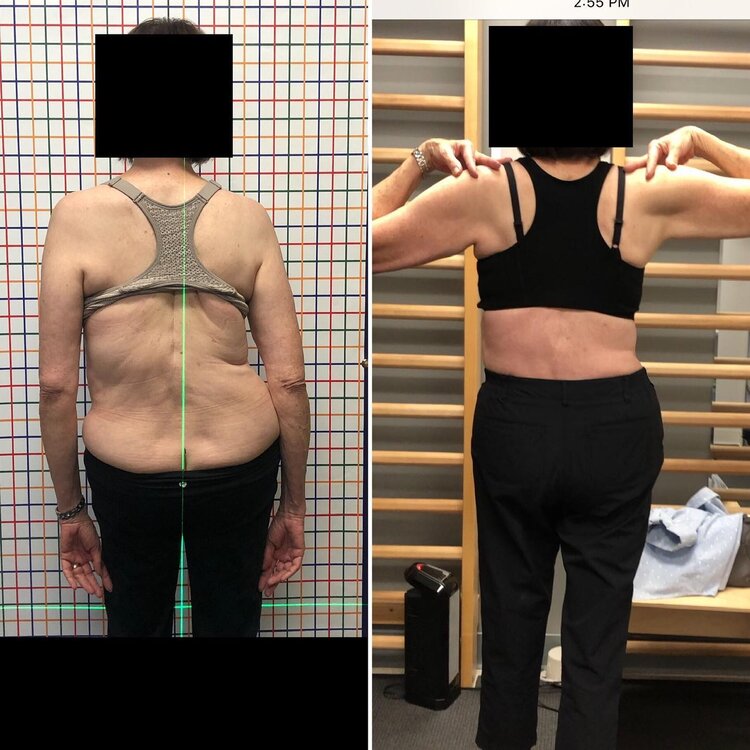 Before and after back photos of an adult patient at the studio