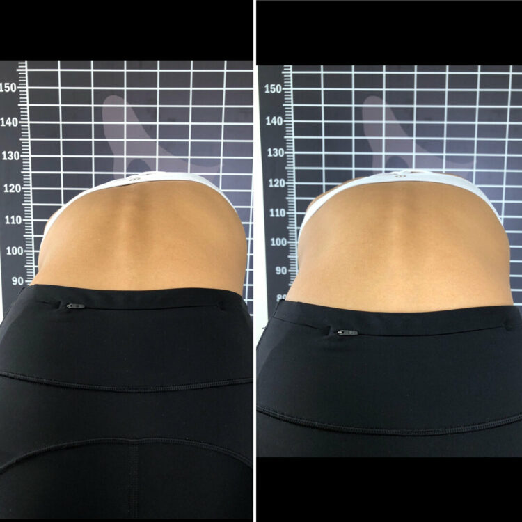 Before and after photos of a patient's back seen from above while bending forward